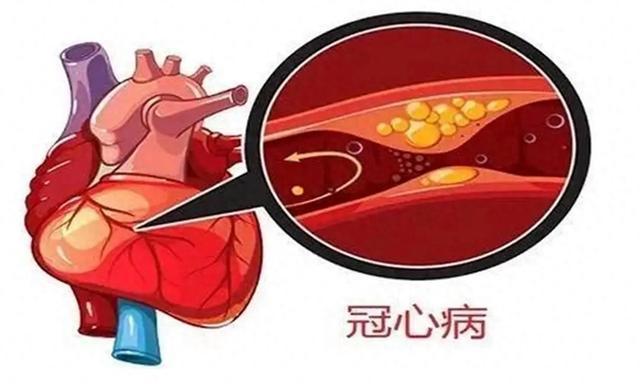 江南·体育(中国)官方网站-JN SPORTS发现：若是冠心病人每天遛弯锻炼或比(图2)